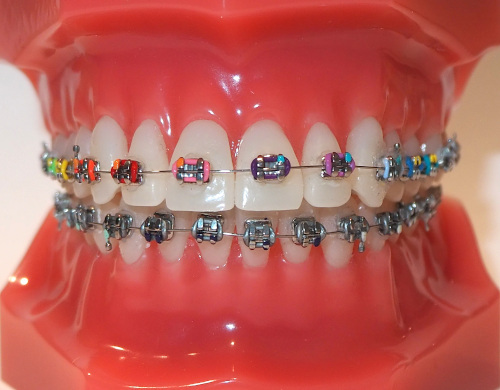 typodont model with metal braces and colours