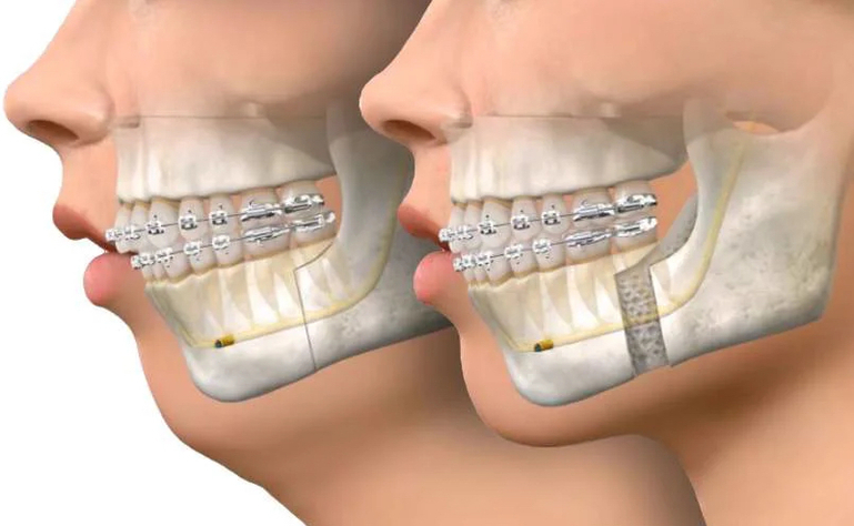 jaw surgery before and after advancement of the mandible