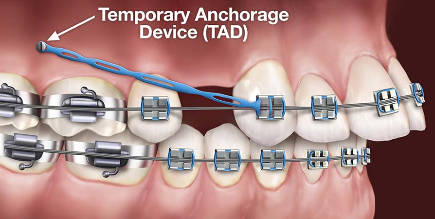 illustration with teeth and braces and a TAD connected with an elastic to the braces